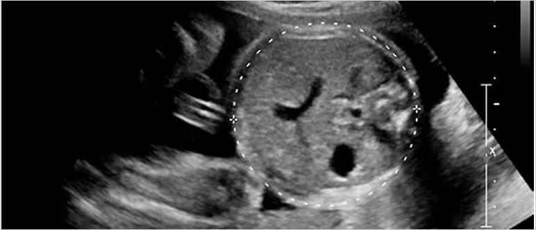 Ultrasound abdominal circumference